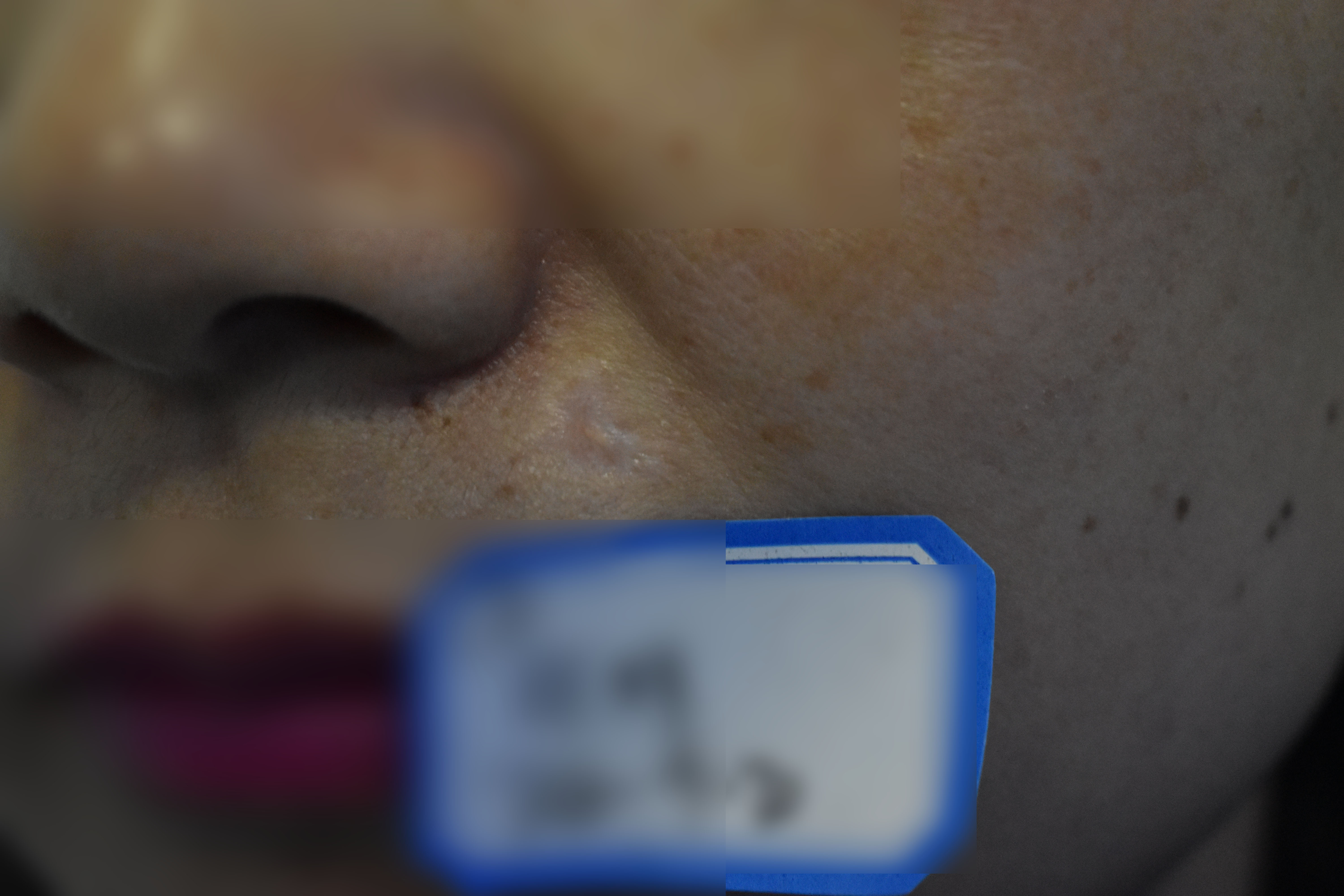 點痣後增生凸起怎麼辦？