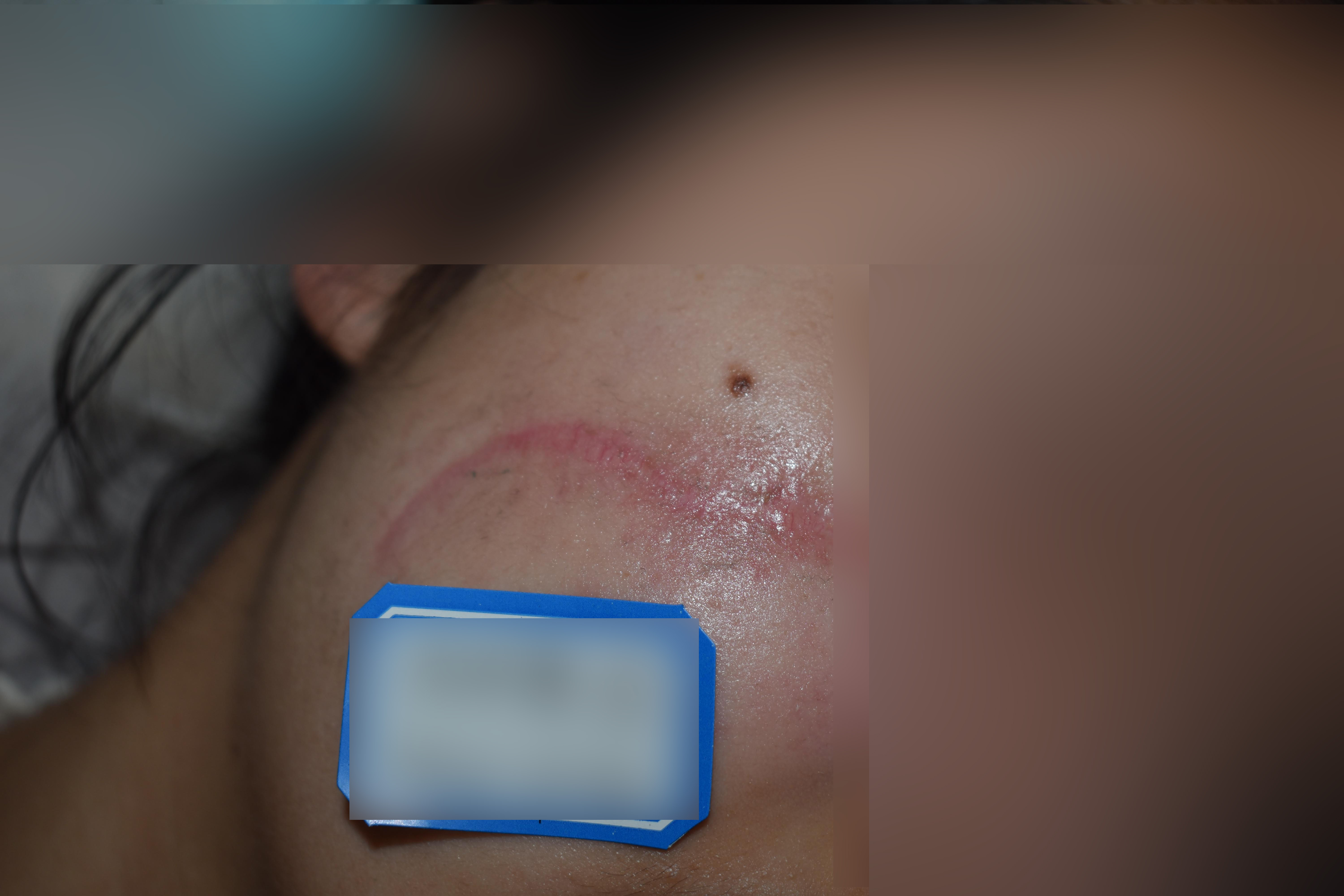 外傷疤痕都分為哪幾類？