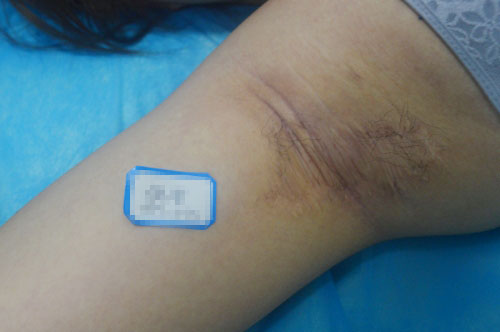 腋臭手術後留下褶皺疤痕怎麼辦？