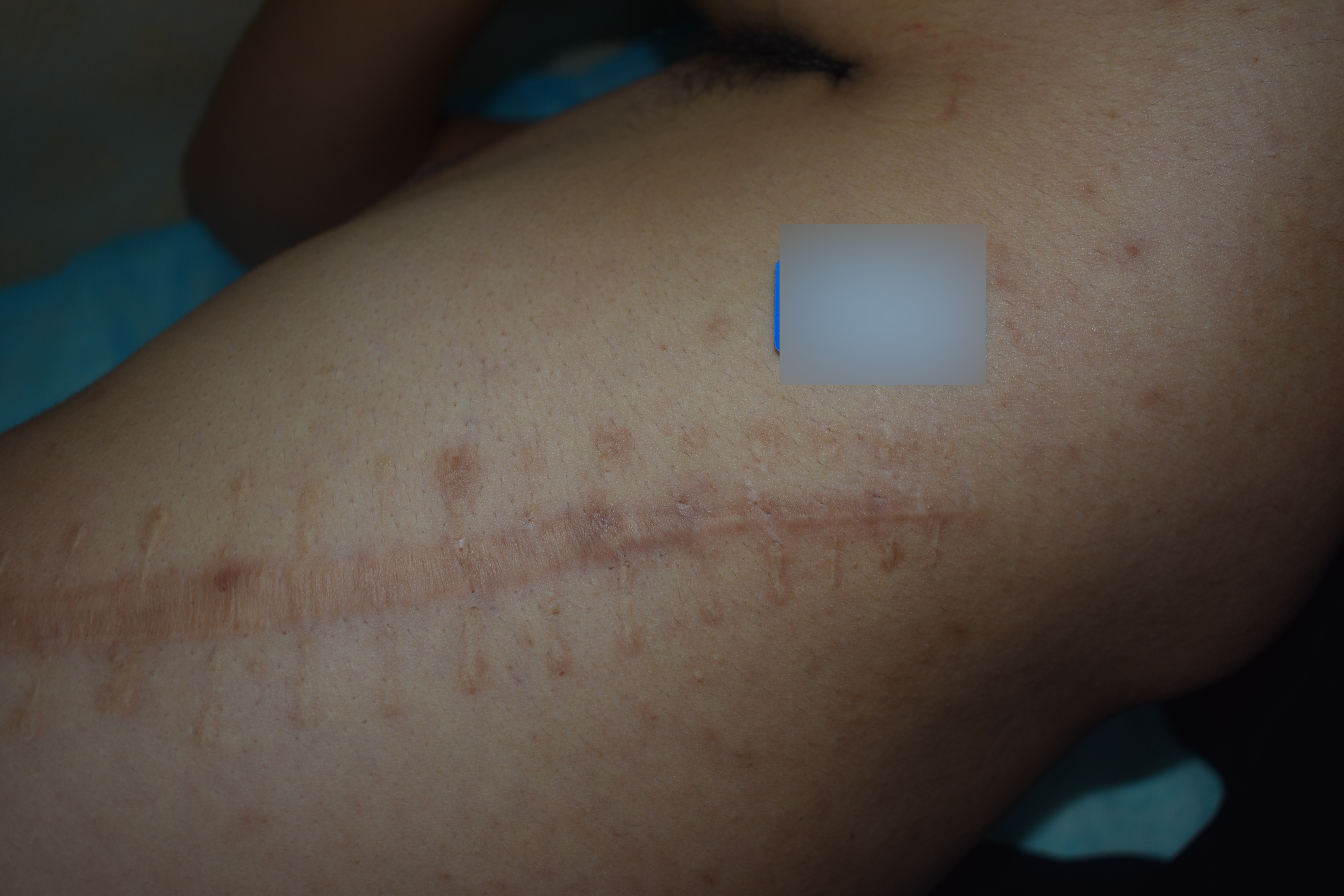 傷口縫針後為什麼會凸出來一道？