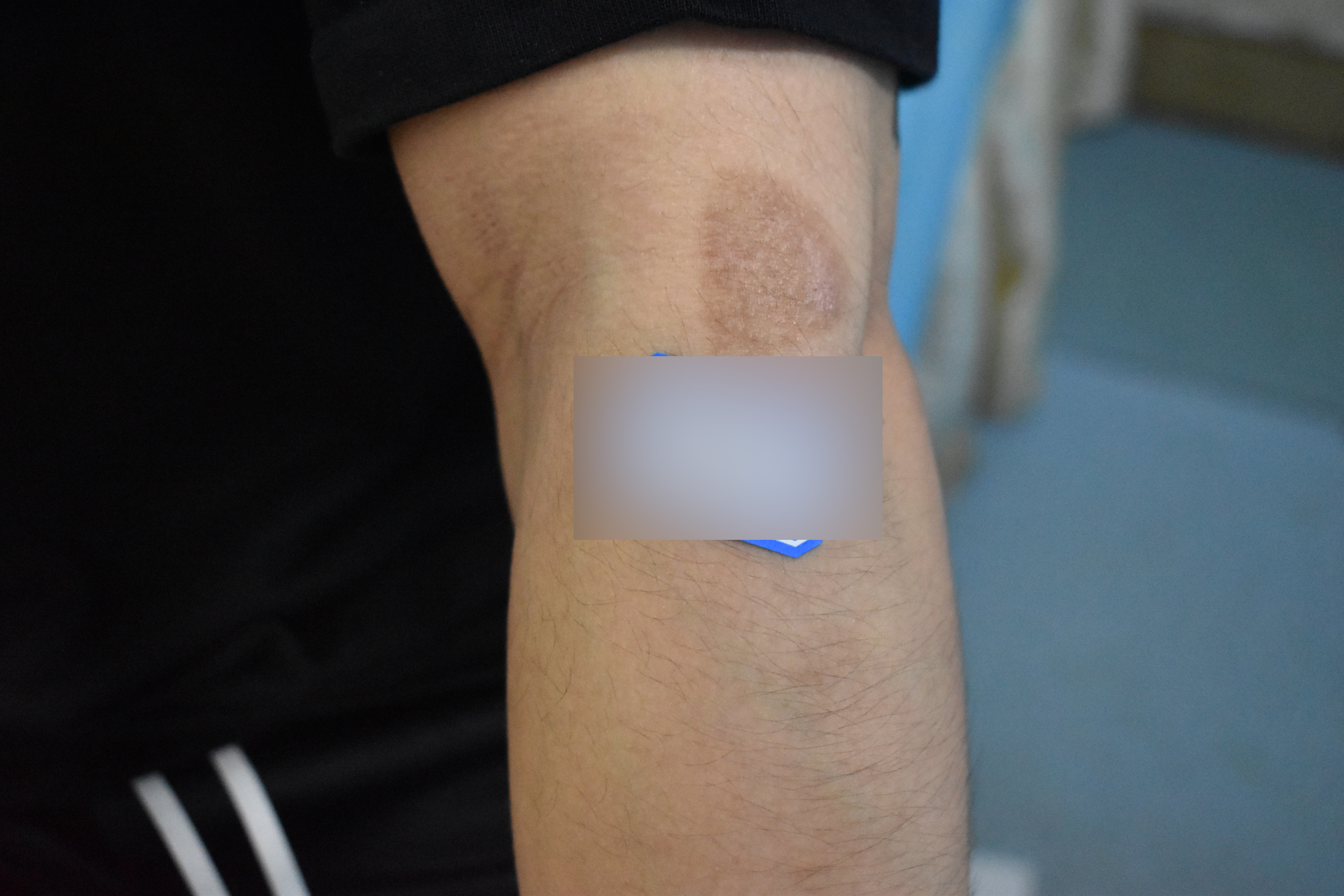 臉上色素疤痕幾年了都不消退是怎麼回事？