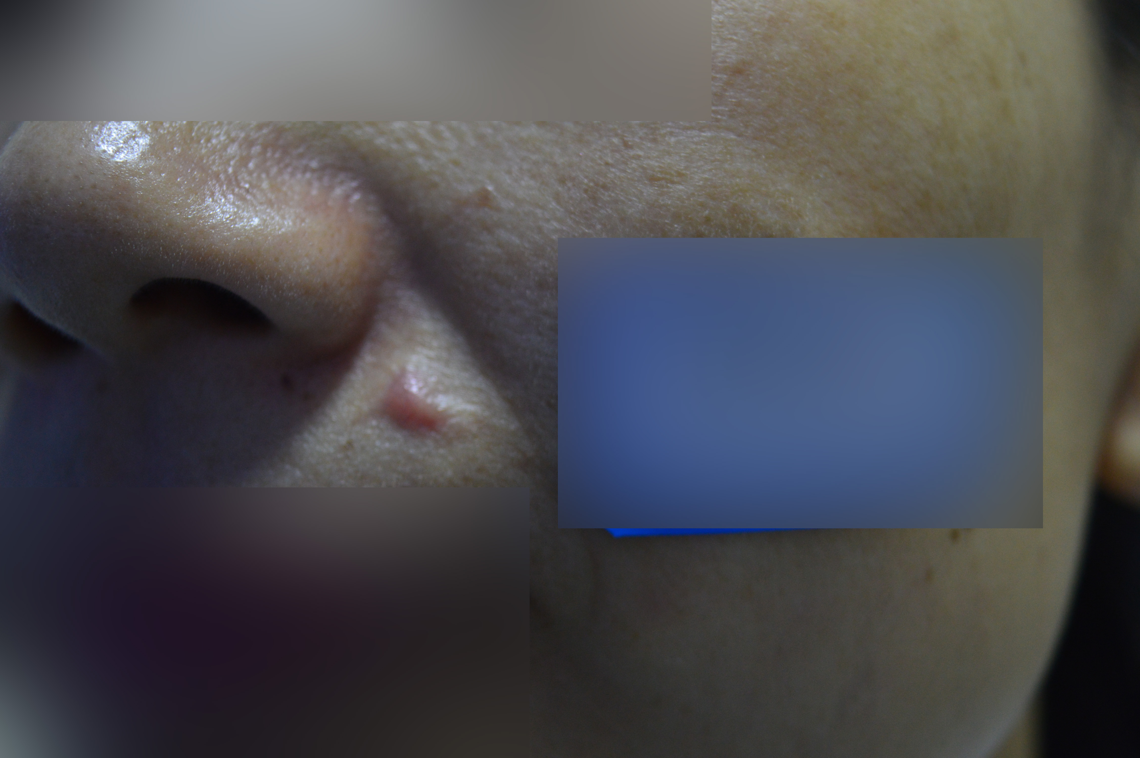 點痣後疤痕多久消失？