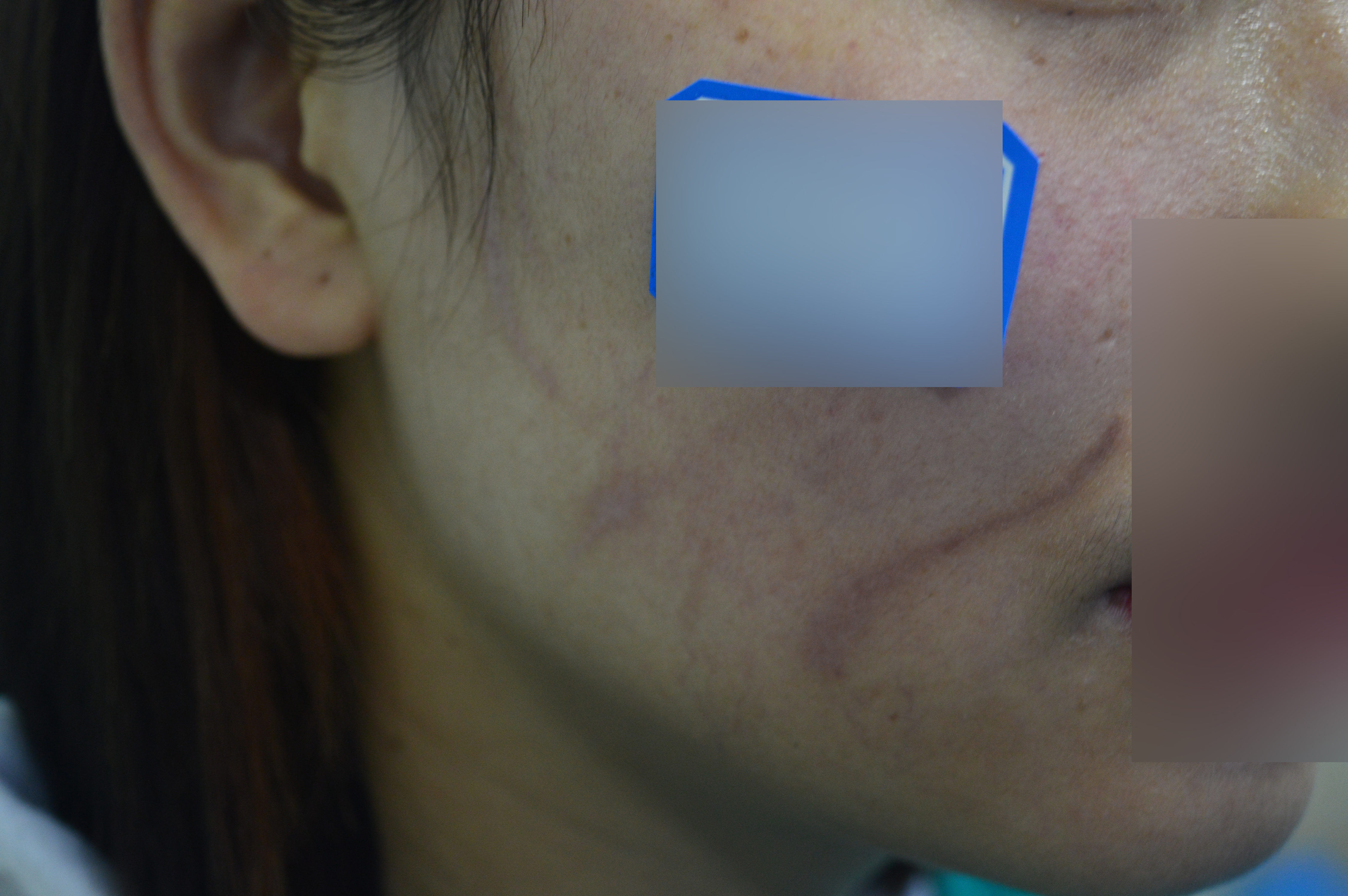 褐色疤痕色素可以減淡嗎？