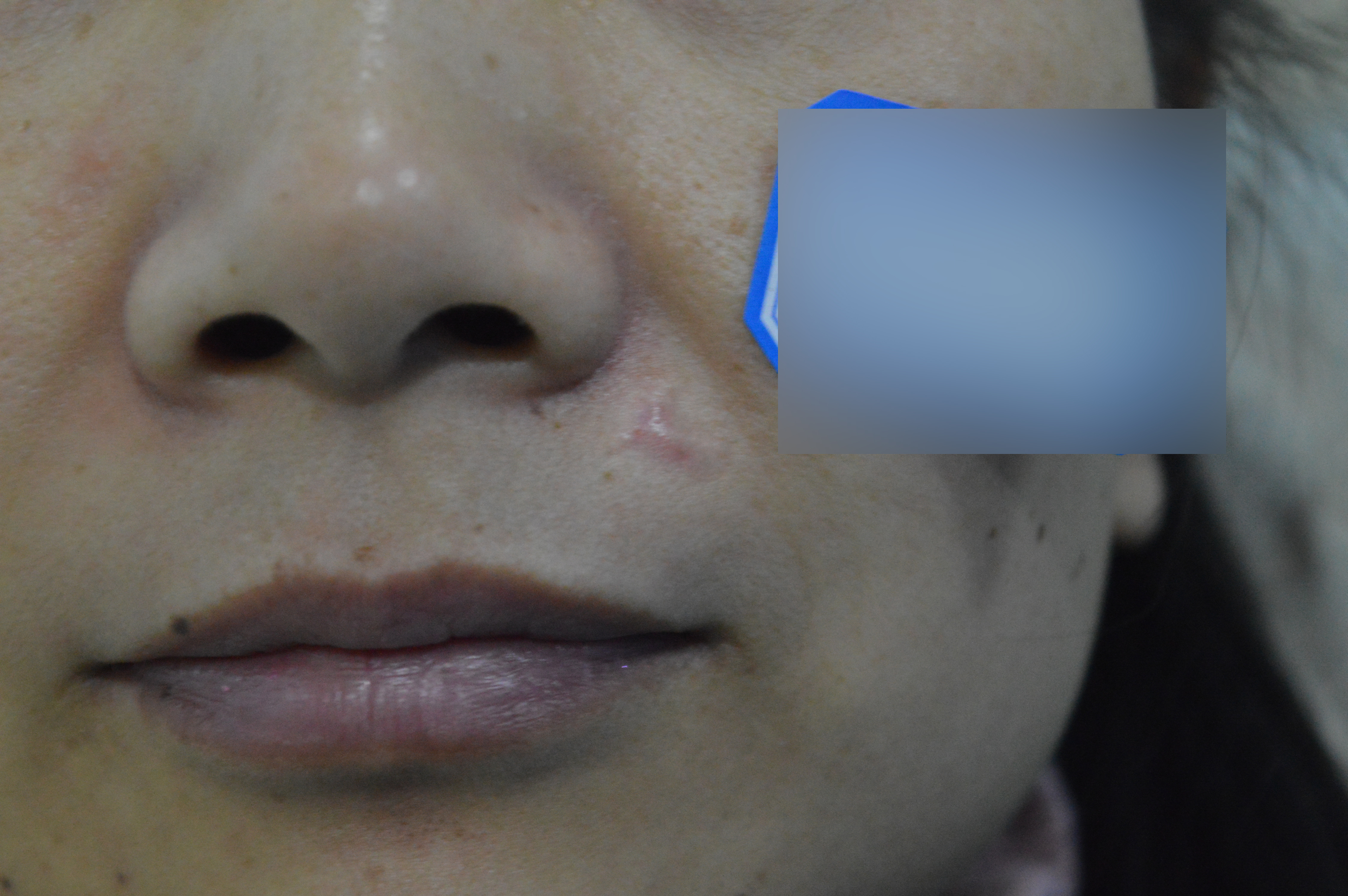 點痣都好幾個星期了，結痂還沒掉正常嗎？