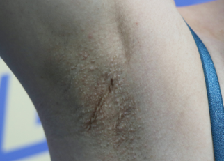 治療和預防相結合才能治癒腋臭手術疤痕。