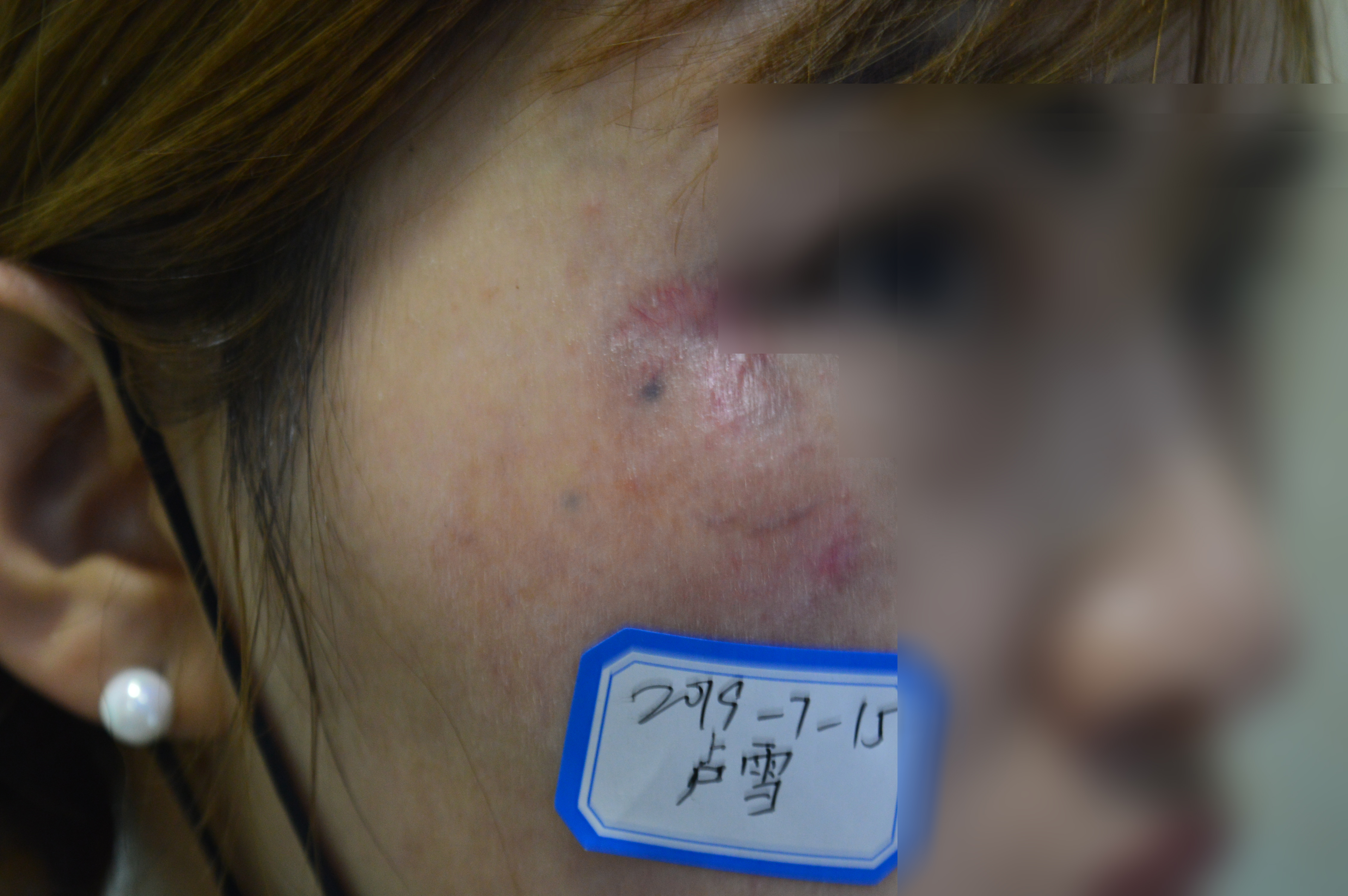 色素疤痕自己會消失嗎？