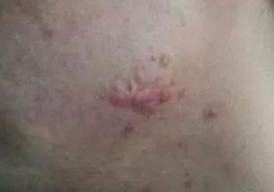 外傷疤都有哪些？