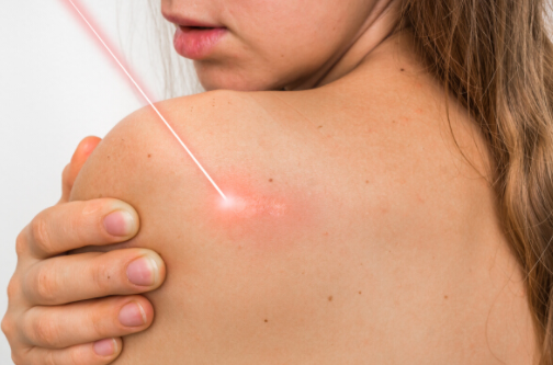 點痣後，留下疤痕怎麼辦？