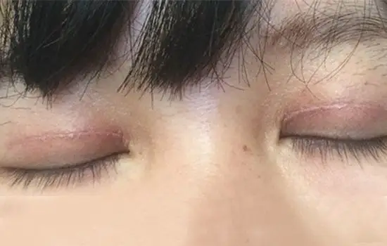 眼瞼疤痕修復時的注意事項