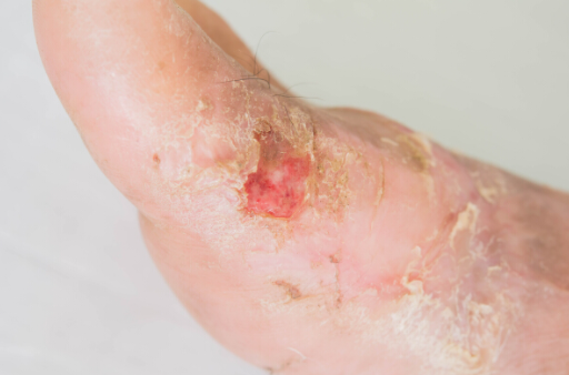 糖尿病患者的皮膚被意外燒燙傷應該怎麼樣處理?