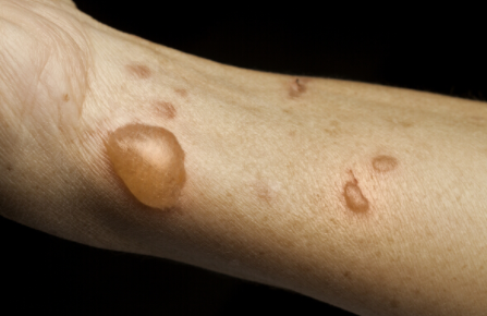 要選擇新鮮的生薑緩解燙傷疤痕