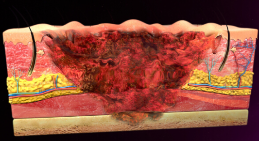 意外燒傷的康復要點