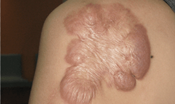 燒傷後怎麼護理，避免疤痕增生