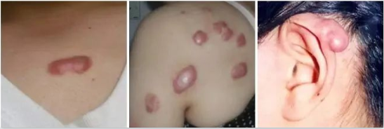 增生性疤痕疙瘩具體表現