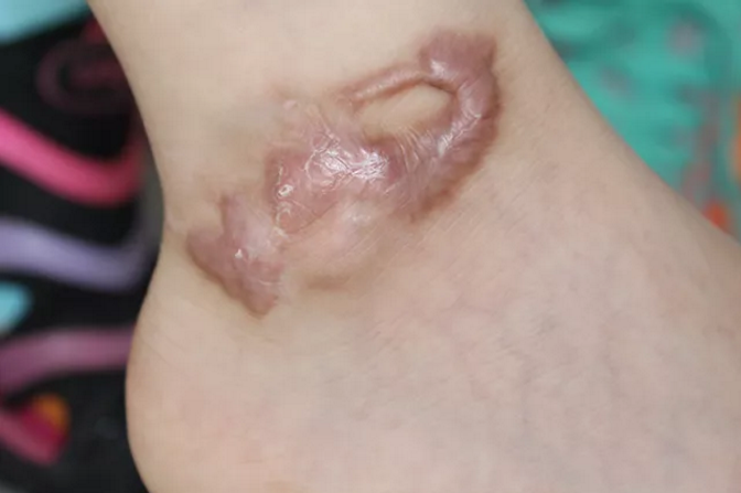 疤痕增生形成原因有哪些