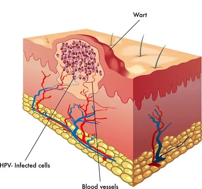痤瘡的預防日常要做好哪些?