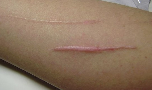 生活中的淡疤方法介紹