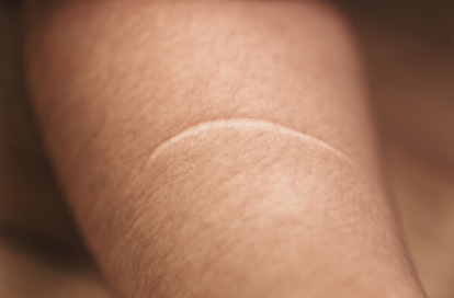 白色凸起增生疤痕怎麼辦？