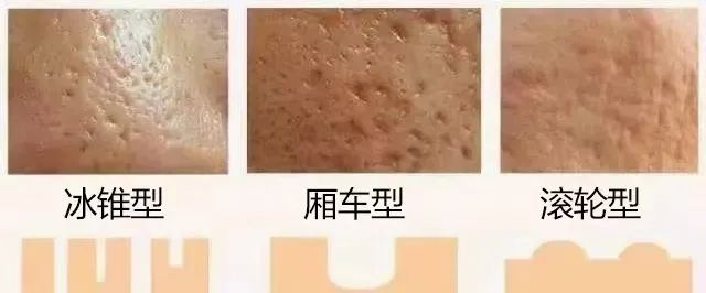 痘印到底是怎麼產生的呢?