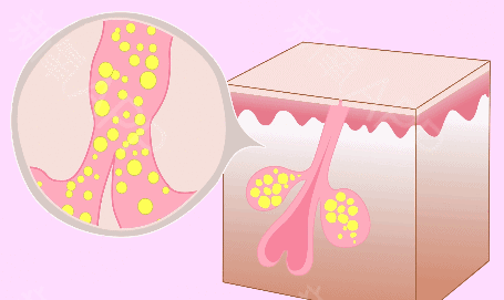 脖子上長痘是因為什麼?