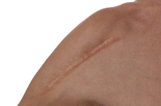 看到這4大危害,你還想用紋身來遮蓋疤痕嗎?