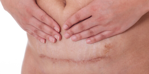 產後疤痕護理注意事項