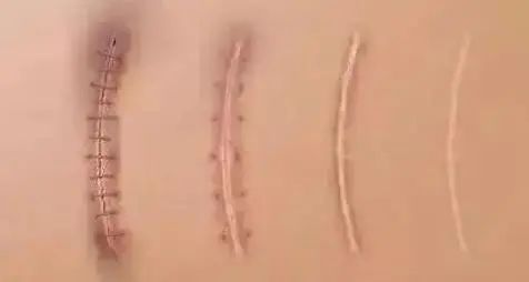 疤痕增生需要多久可以變平？