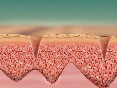 凹陷性疤痕對我們的影響