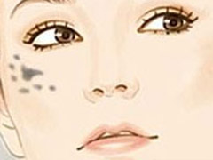 避免色素疤應該注意什麼