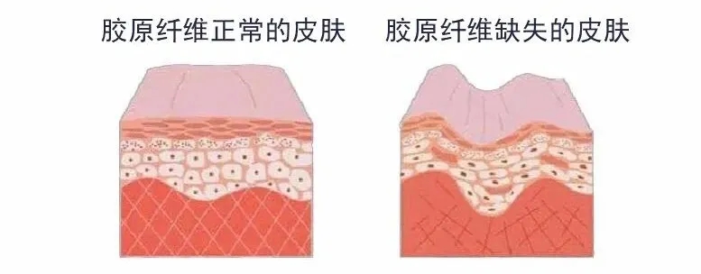 凹陷疤痕修復大概多少錢