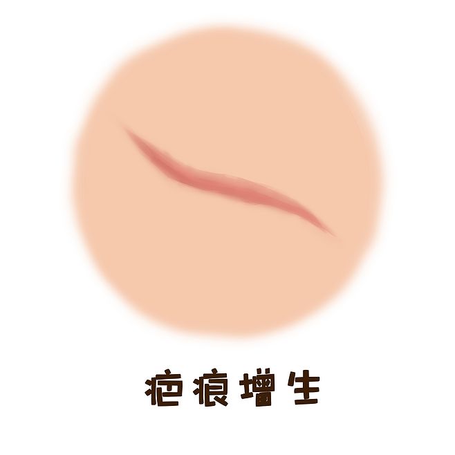 疤痕增生的6大因素