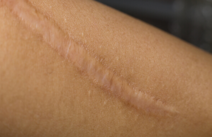 疤痕修復副作用和護理