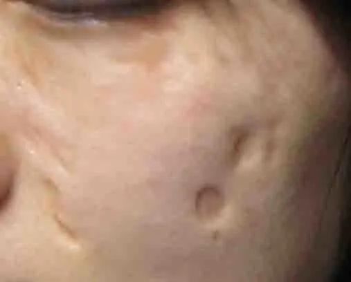 痤瘡留下的疤痕如何能夠去掉