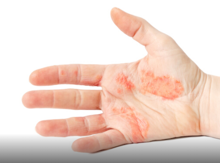 各種燒傷如何應急處理