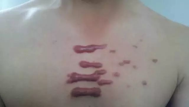 了解疤痕的概念和危害性