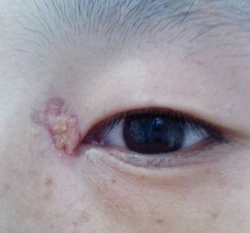 開眼角疤痕多久消失