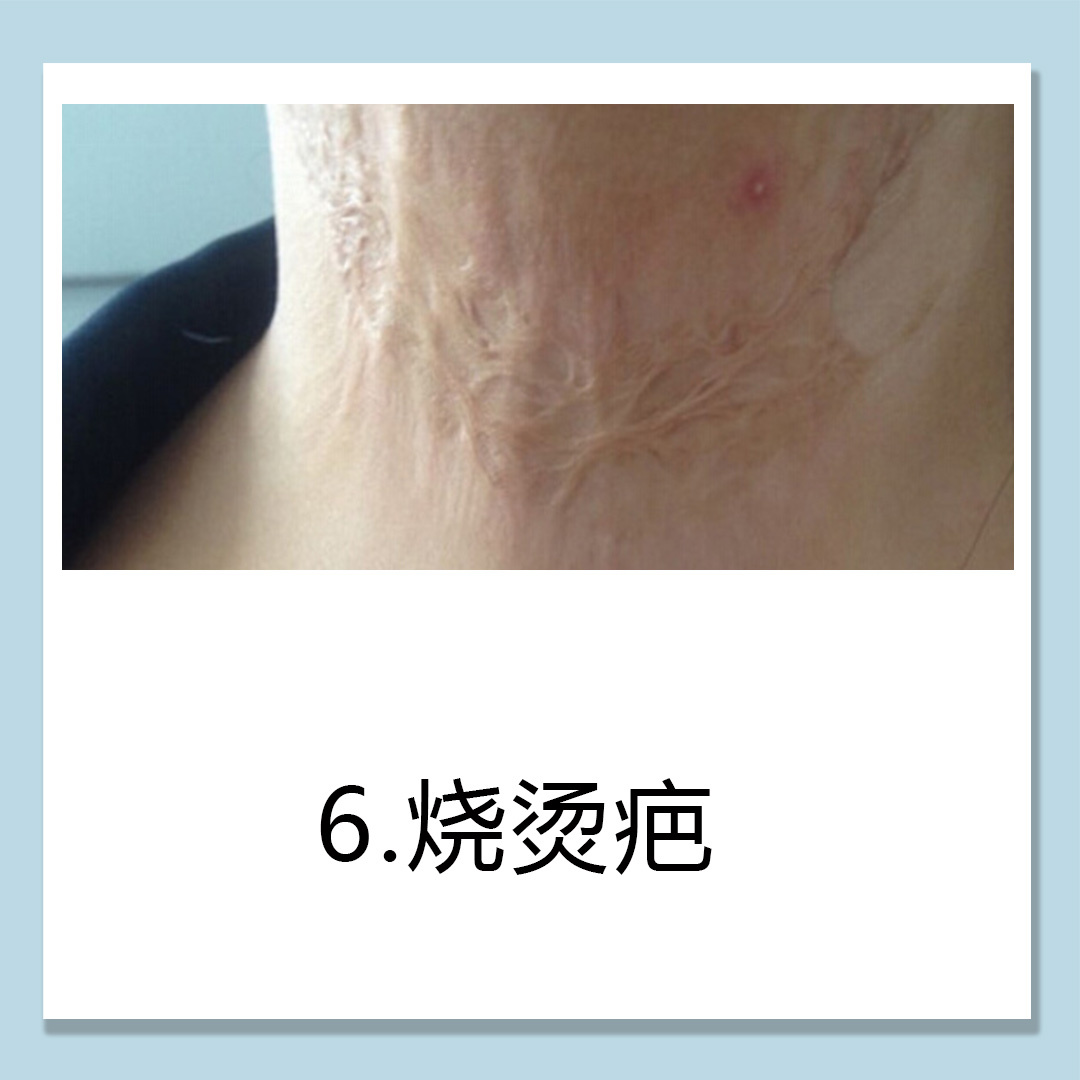 燒傷怎麼預防保健