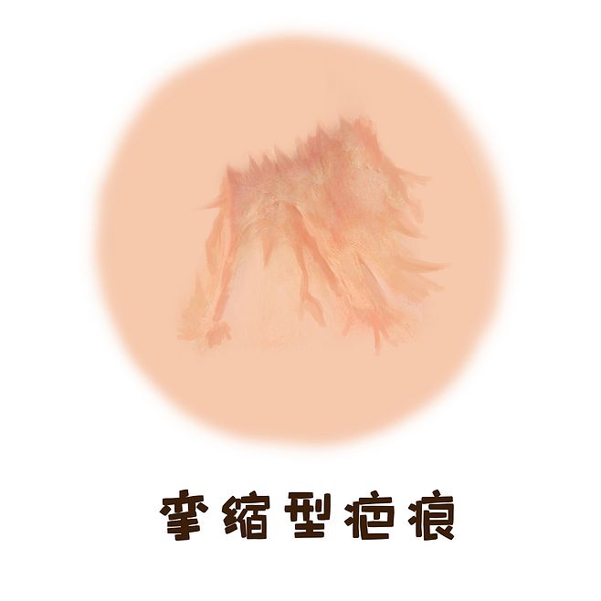 攣縮性疤痕修復過程以及危害