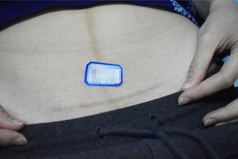 縫針疤痕幾年後可以淡化?