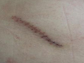 深圳去除手術疤痕的方法有哪些