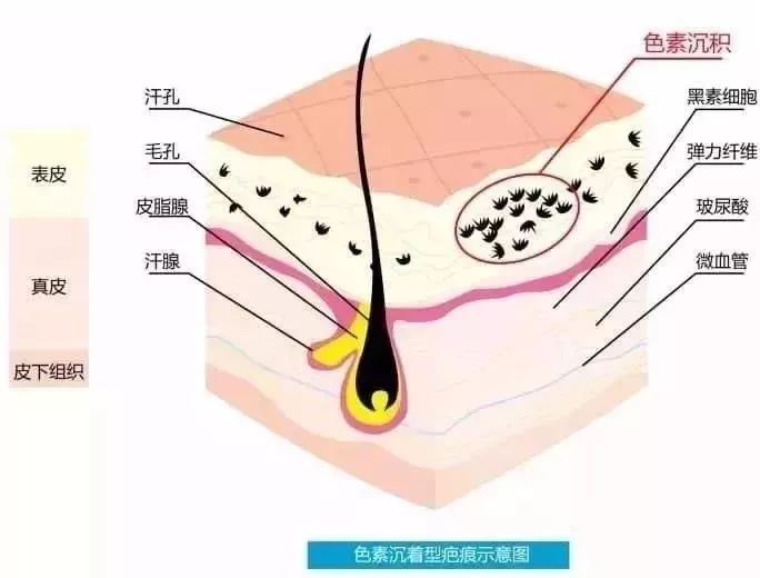 色素疤痕怎樣治療?有什麼好的建議嗎？