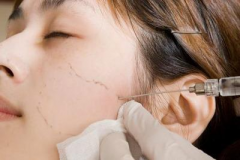 臉部三厘米長的凹陷疤痕，可以打玻尿酸填平嗎